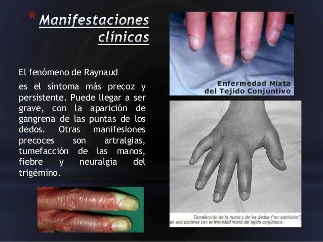 enfermedad mixta del tejido conectivo